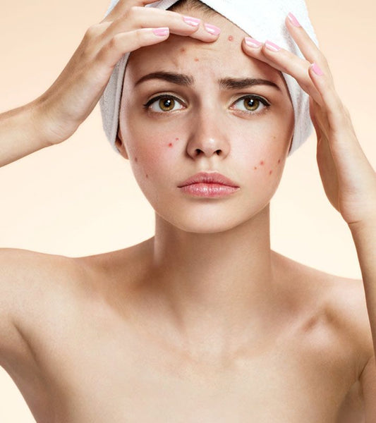 ¿Cómo el acné puede estar afectando en tus oportunidades?